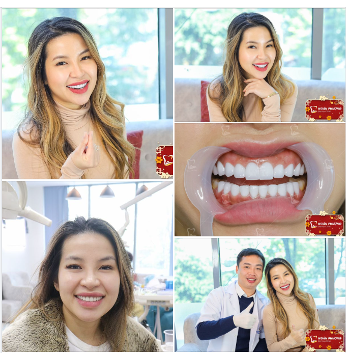 Làm lại sứ, nâng tone màu răng cho chị khách Việt kiều