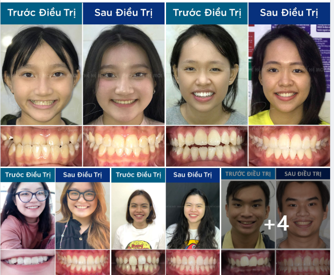 LÝ DO LỰA CHỌN NIỀNG RĂNG TẠI NHA KHOA THẾ HỆ MỚI