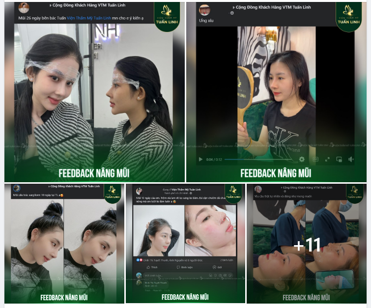 Feedback Nâng mũi tại Tuấn Linh!!