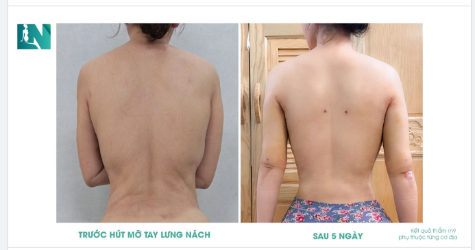Bên dưới là hình ảnh của Chị Thuý Nga (46 tuổi) gửi về cho Ekip  Bác sĩ Lương Ngọc