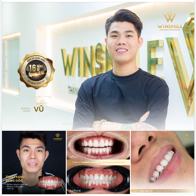 CỨU NGUY CA RĂNG SỨ HỎNG GÂY VIÊM LỢI NẶNG
