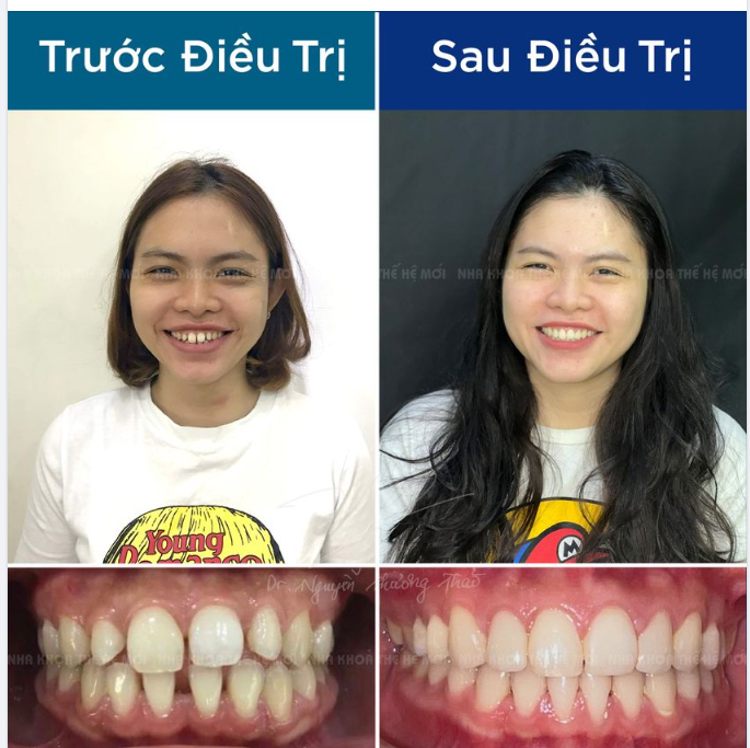 Nụ cười tự tin rạng rỡ sau chỉnh nha. Bạn có nhận thấy sự khác biệt từ nữ khách hàng này ?