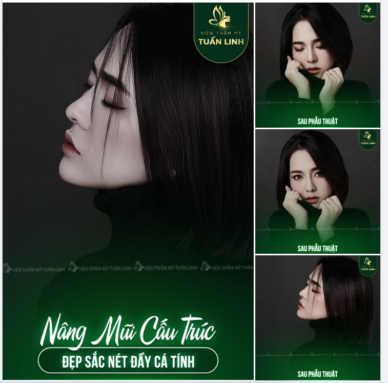 Nâng mũi cấu trúc - Giải pháp hoàn hảo cho các nàng muốn sở hữu chiếc mũi cao xinh chuẩn form cho nhan sắc đẹp rạng ngời!!