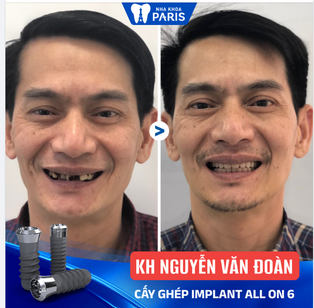 Khách hàng Nguyễn Văn Đoàn - Trồng răng 2 hàm All On 6 trụ ETK Paris