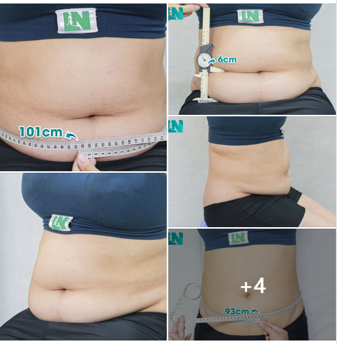  HÚT MỠ TẠO DÁNG THẨM MỸ CHO CHỊ KH U50