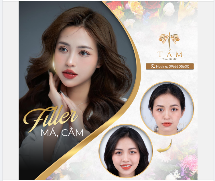 FILLER - Giải pháp hoàn hảo cho các nàng muốn năm mới đẹp sang nhưng e sợ phẫu thuật thẩm mỹ