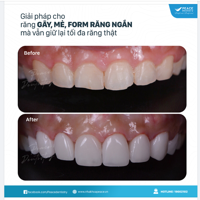 Ca lâm sàng 4 mặt dán sứ Veneer - tự nhiên và hạn chế tối thiểu xâm lấn răng thật