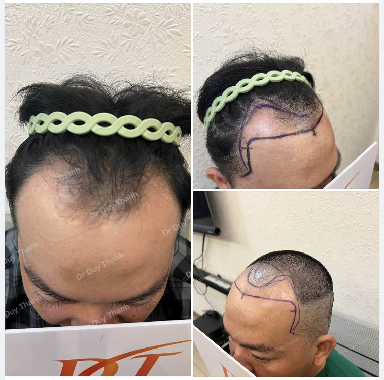 CHUẨN BỊ CẤY 2000 NANG, BOY KIÊN GIANG 34 TUỔI