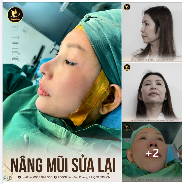 NÂNG MŨI SỬA LẠI DR. HOẠT