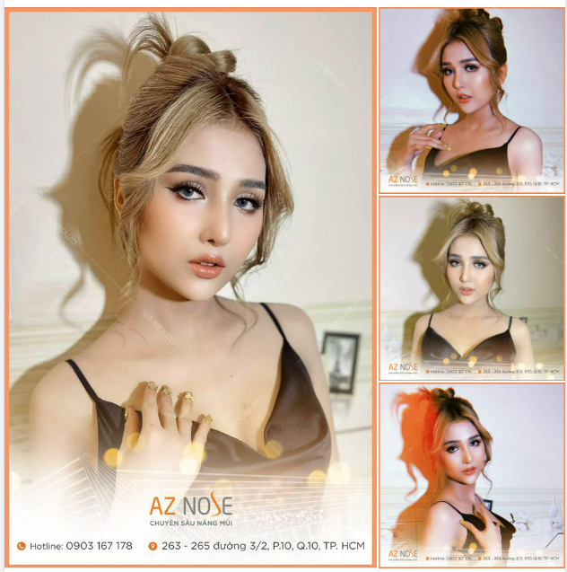 Dáng mũi Sline cao hài hòa sau 16 ngày tái tạo mũi h.ỏng
