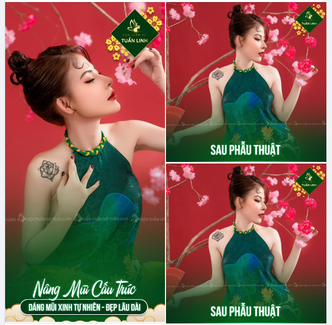 NÂNG MŨI CẤU TRÚC - DÁNG XINH TỰ NHIÊN - ĐẸP LÂU DÀI