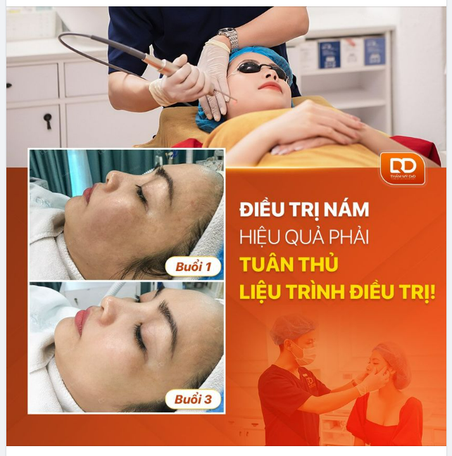 ĐIỀU TRỊ NÁM HIỆU QUẢ PHẢI TUÂN THỦ LIỆU TRÌNH ĐIỀU TRỊ!