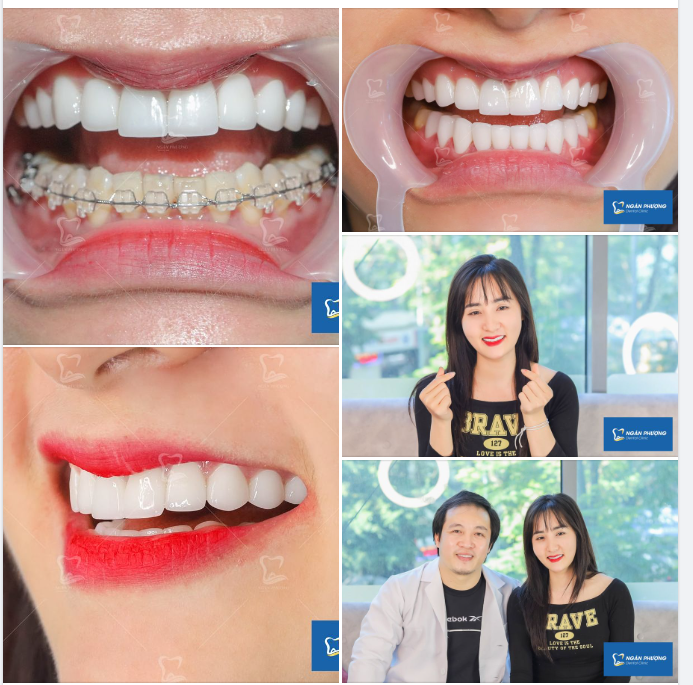 Tháo niềng rồi làm sứ