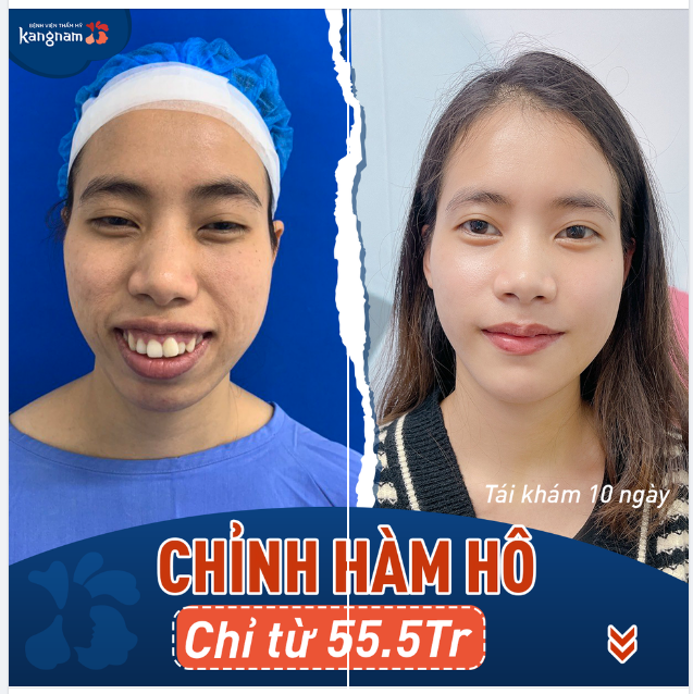 Hàm hô - Răng vẩu - Cằm lẹm