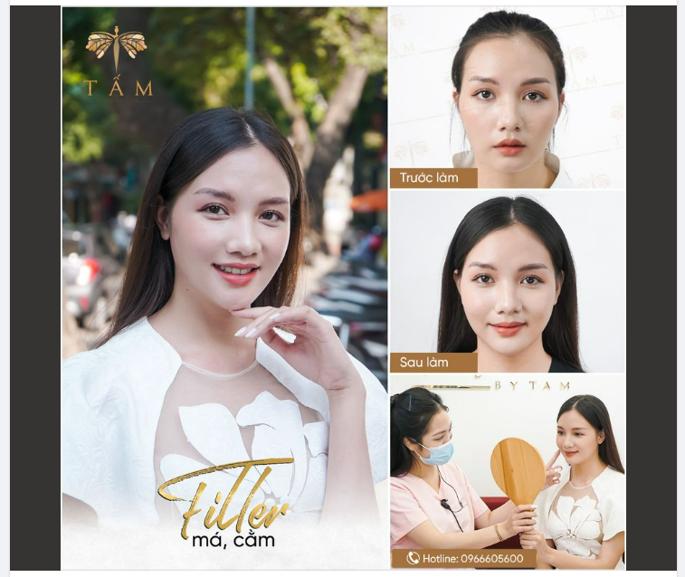 Không cần đến 1 tháng, đẹp hoàn hảo ngay sau khi làm với COMBO FILLER tại Tấm.