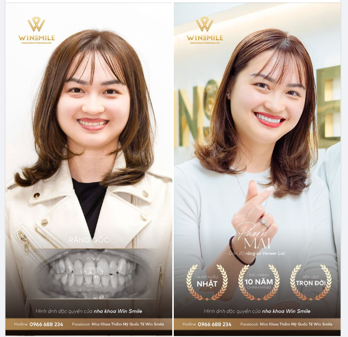 CHINH PHỤC VẺ ĐẸP TINH TẾ TỪ NỤ CƯỜI VENEER