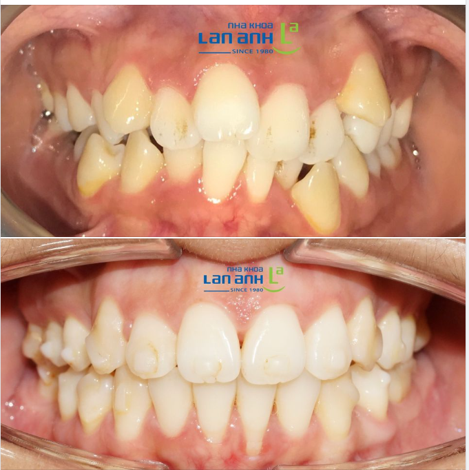 Một trường hợp niềng răng Invisalign tại chi nhánh 149 Tôn Dật Tiên, quận 7, bác sĩ Tuấn Anh điều trị!