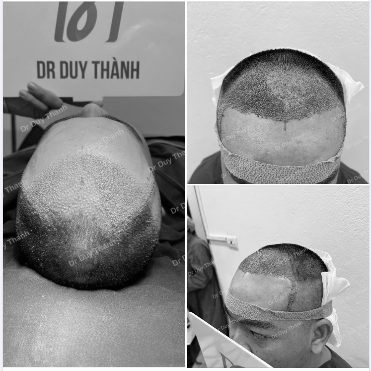 TRẢ KẾT QUẢ SAU CẤY 2000 NANG TÓC- BOY KIÊN GIANG