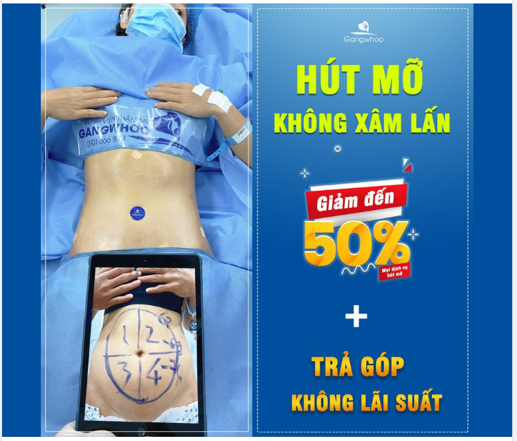HÚT MỠ KHÔNG XÂM LẤN - TẠO DÁNG THON ĐẸP KHÔNG CẮT DA DƯ