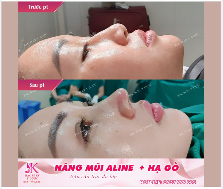 Mũi thấp và gồ thì phải làm sao? Đến ngay Bác sĩ Kỳ Y Dược để tạo dáng mũi thanh tú.