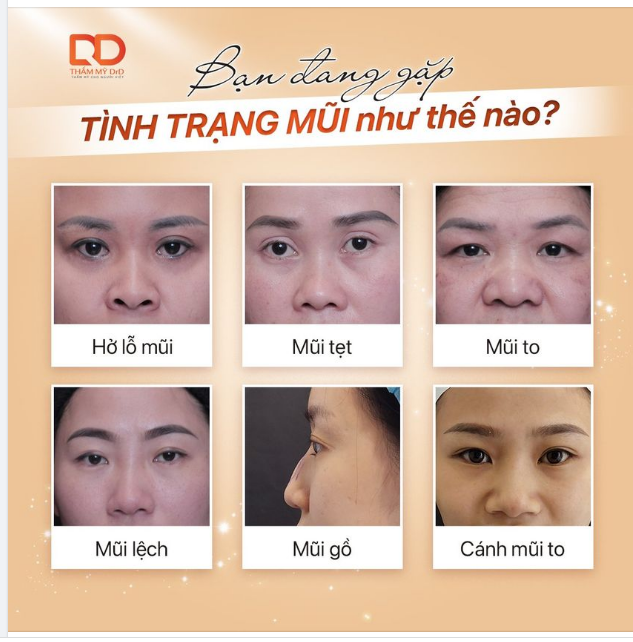 MŨI CÓ KHUYẾT ĐIỂM NÀO? SỬA KHUYẾT ĐIỂM ĐÓ