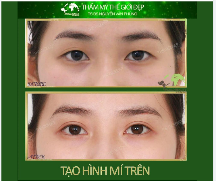Tuy không mất nhiều thời gian nghỉ dưỡng nhưng quý Chị em vẫn xinh đẹp rạng rỡ và đầy tự tin đón Tết chỉ với tiểu ph.ẫu Tạo hình mí trên.