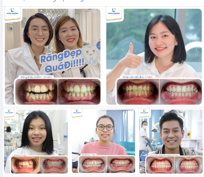 Niềng răng mất bao lâu?