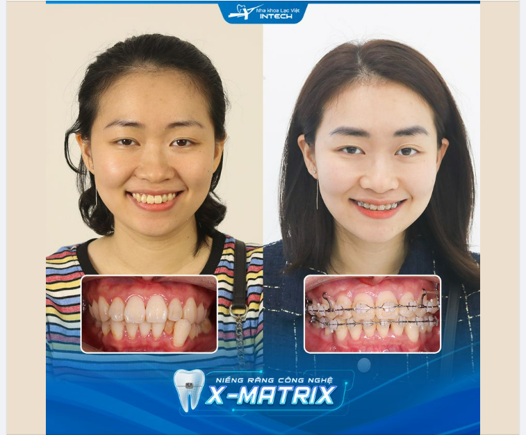 20 THÁNG NIỀNG RĂNG CÔNG NGHỆ X-MATRIX THAY ĐỔI NHƯ THẾ NÀO?