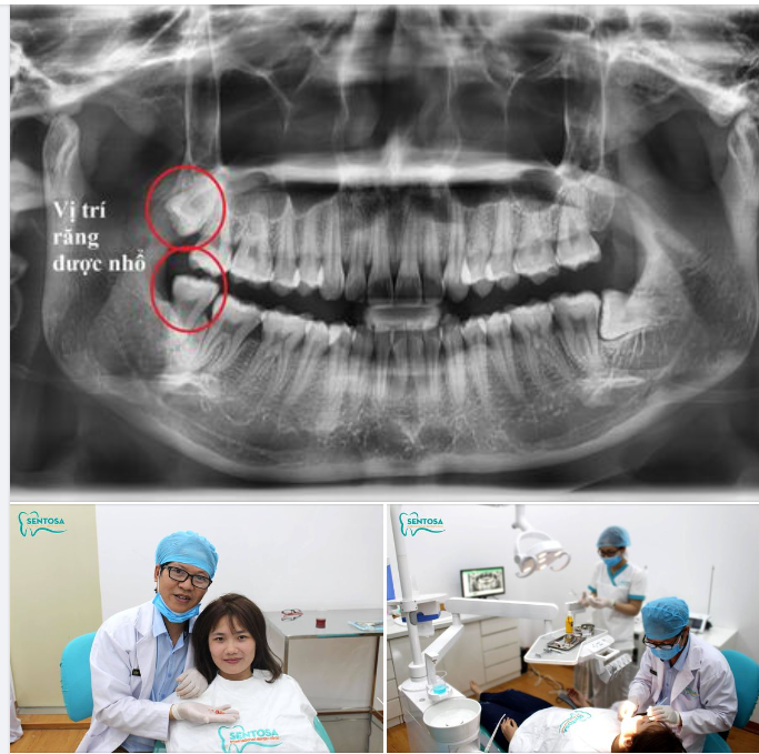 HÌNH ẢNH KHÁCH HÀNG NHỔ RĂNG KHÔN