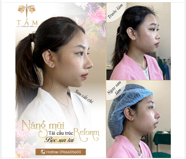 Hình ảnh thực tế của cô nàng hot TikToker Yung nâng mũi tái cấu trúc Reform tại Thẩm mỹ viện Tấm