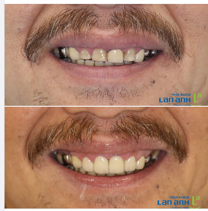 Một ca làm răng sứ 4 răng cửa tại chi nhánh Sala, bác sĩ Thảo điều trị!