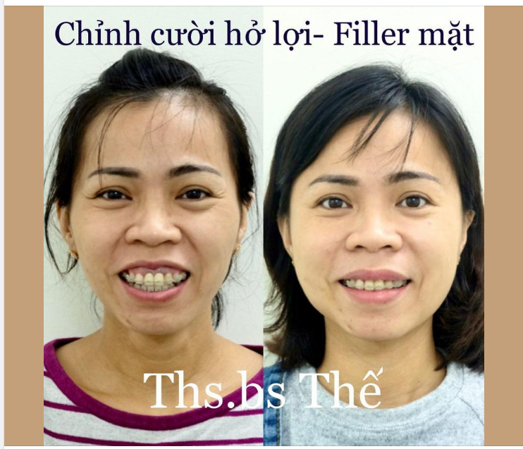 Cười hở lợi sẽ chỉnh sửa bằng 2 cách: