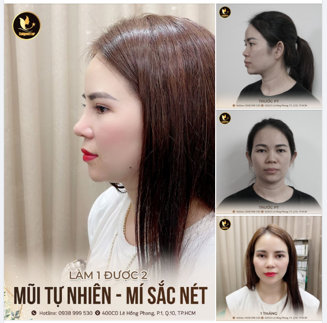 Làm 1 được 2 MŨI ĐẸP TỰ NHIÊN – MÍ SẮC NÉT