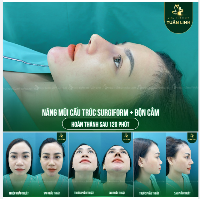 COMBO NÂNG MŨI + ĐỘN CẰM  XU HƯỚNG LÀM ĐẸP NĂM 2023 ĐƯỢC ĐÔNG ĐẢO KHÁCH HÀNG YÊU THÍCH.