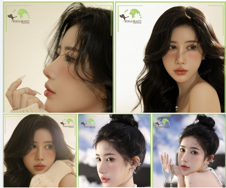 hông hài lòng với lần n.âng cấp trước đó, 9X tìm đến Thế Giới Đẹp mong muốn khắc phục những khuyết điểm mũi cũ: