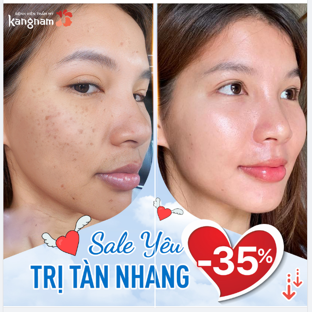 Da đẹp Mùa yêu Trị tàn nhang chỉ từ 6,5TR