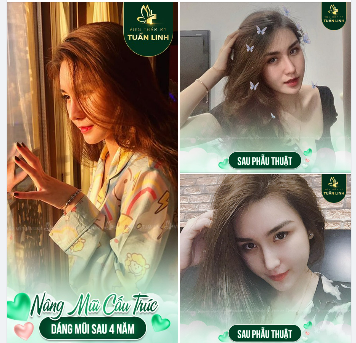 NÂNG MŨI CẤU TRÚC - DÁNG MŨI SAU 4 NĂM