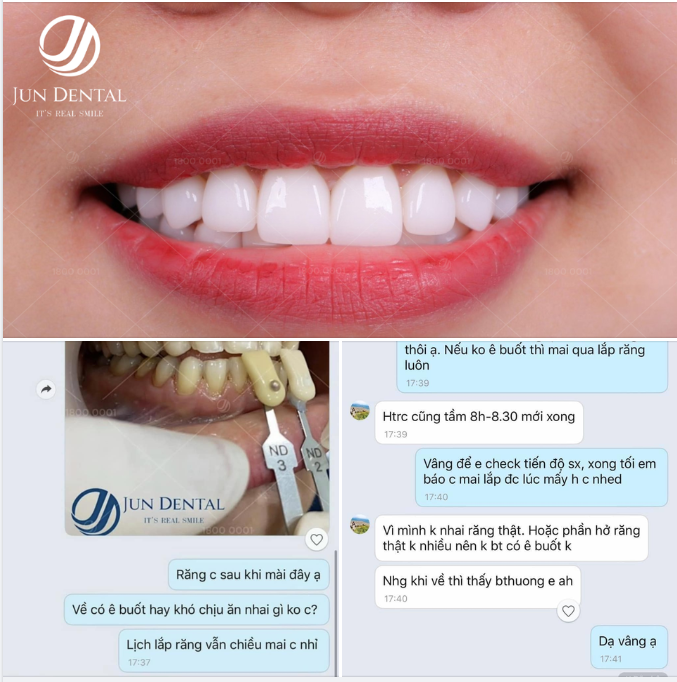 DÁN SỨ THAY ĐỔI DIỆN MẠO NỤ CƯỜI CỦA CHỊ HOA KHÔI NGÀNH TÒA ÁN TẠI JUN DENTAL