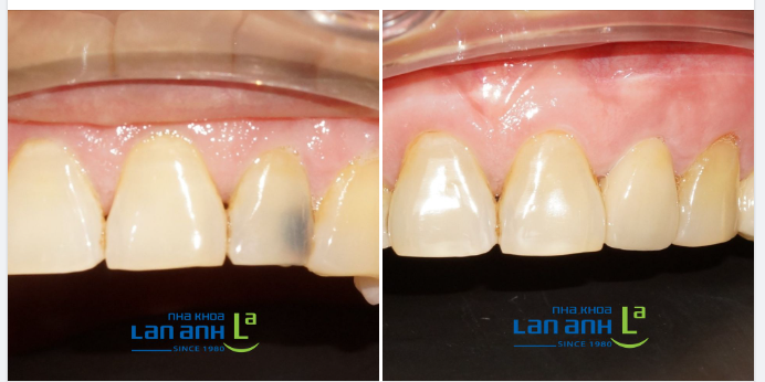  Một trường hợp làm răng sứ CERCON tại chi nhánh 149 Tôn Dật Tiên, quận 7, do bác sĩ Dũng điều trị!