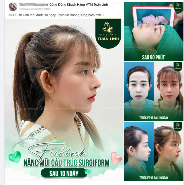 FEEDBACK NÂNG MŨI CẤU TRÚC SURGIFORM SAU 10 NGÀY!