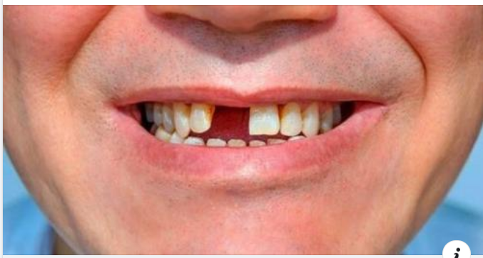 Không trồng răng giả sau khi nhổ răng có sao không?