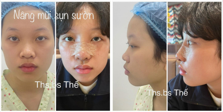 Nâng mũi thuận tự nhiên.