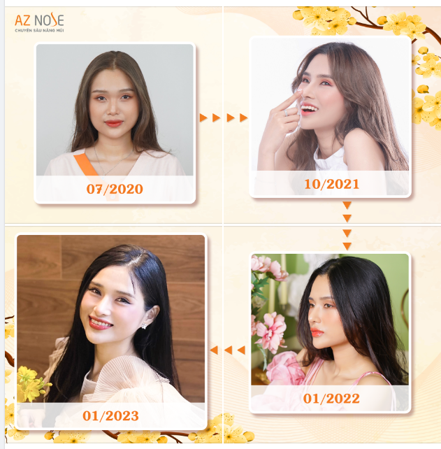 Đây là lí do vì sao bạn nên chọn nâng mũi ngay hôm nay!