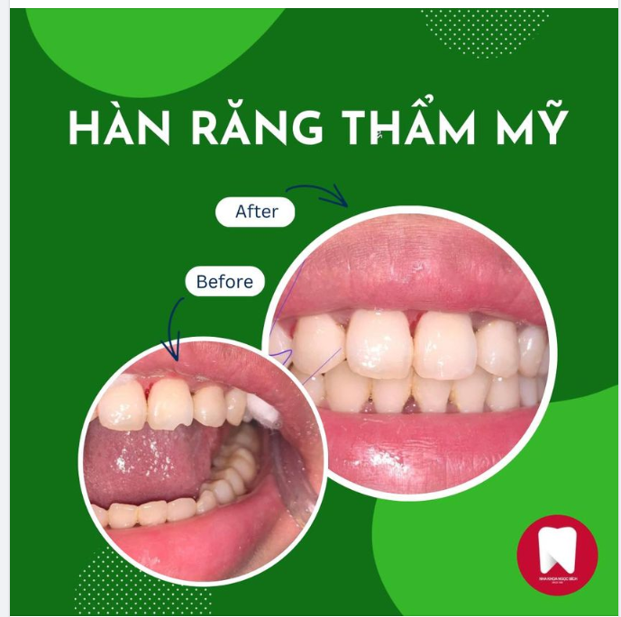 TRƯỜNG HỢP NÀO CẦN HÀN RĂNG THẨM MỸ