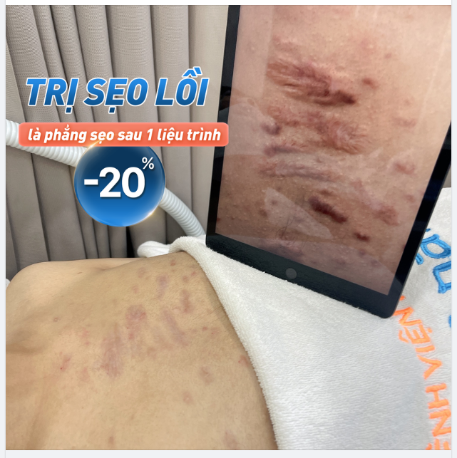 Sẹo lồi khiến bạn buồn phiền cả năm. Đầu xuân sửa sẹo xua tan ưu phiền, tự ti năm cũ
