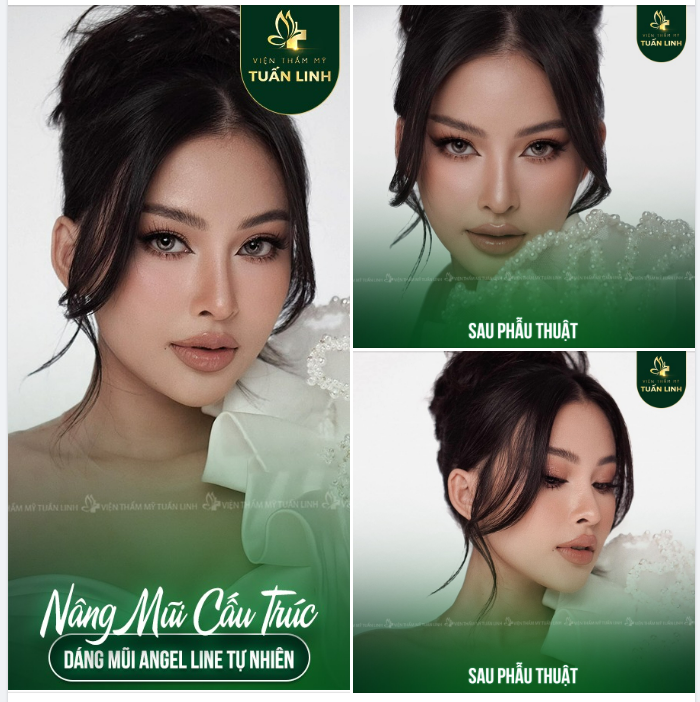 Nâng mũi cấu trúc - Dáng mũi đẹp tinh tế, thời thượng 