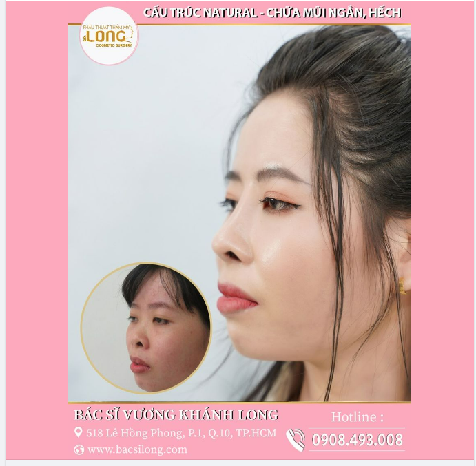 LẦN ĐẦU NÂNG MŨI KIỂU…