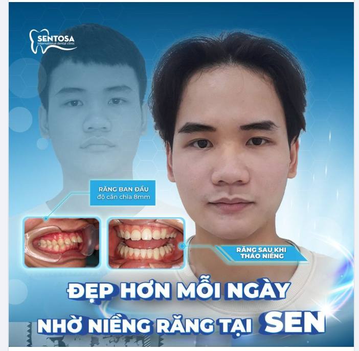 ĐẸP HƠN MỖI NGÀY NHỜ NIỀNG RĂNG TẠI SENTOSA