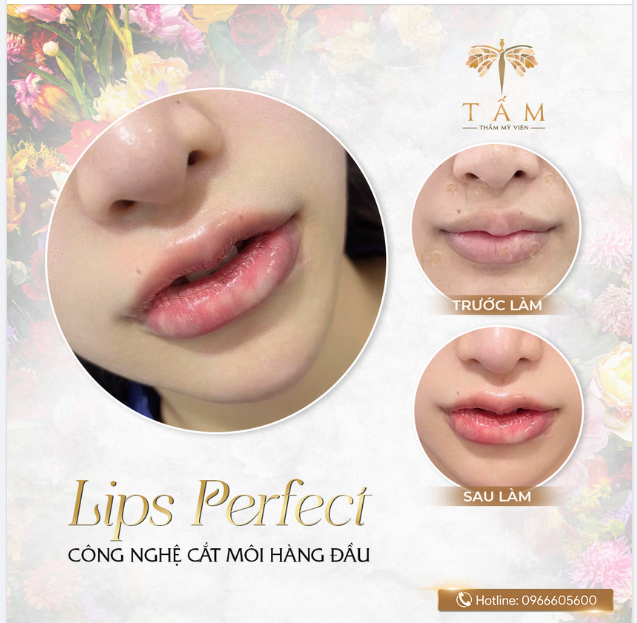 Môi dày thô, vều, kém duyên. Chỉ hơn 30 phút thực hiện, trả lại đôi môi cân đối, hài hòa với gương mặt