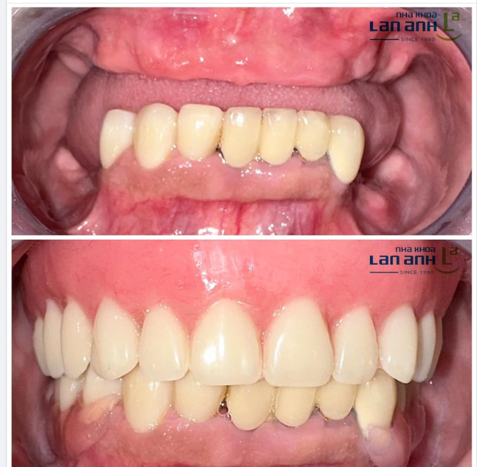Hình ảnh trước và sau khihình 14 răng Composite hàm trên, 7 răng Composite và cầu 3 răng Cercon hàm dưới.